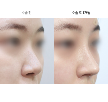 코수술 자연스러운 콧대 라인은 어떻게 선택하나요?
