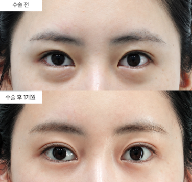 이마거상 후 재수술, 언제 고려하는 게 맞을까요?