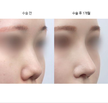 코수술 후 콧대 라인, 어떻게 결정되는 건가요?
