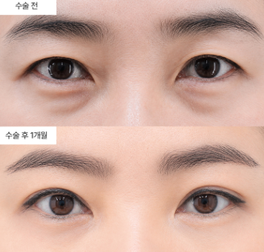 눈밑지방재배치 후 피부가 울퉁불퉁해지는 이유가 뭔가요?