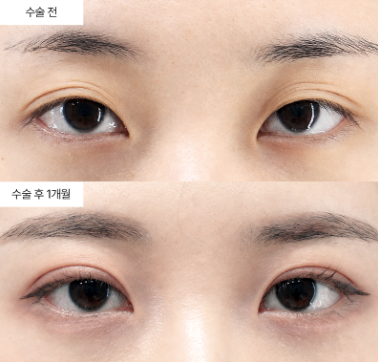 눈매교정 재수술, 언제 고려해야 할까요?