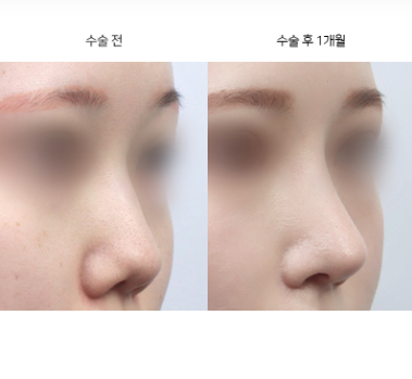 콧대성형이 자연스럽지 않다는 게 사실인가요?