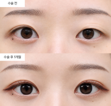 눈매교정 라인, 어떻게 선택하는 게 좋을까요?