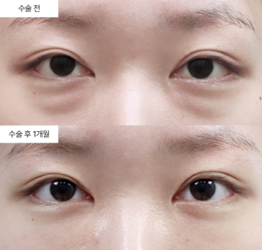 눈밑지방재배치, 적절한 수술 시기는 언제일까요?