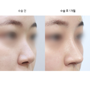 코수술할 때 콧대 라인은 어떻게 정하나요?