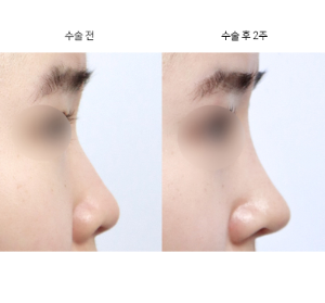 매부리코 수술 후 재수술, 언제 고려하면 좋을까요?