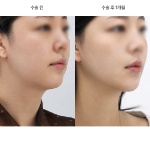 실리프팅 왜 금방 풀린다고 하는 건가요?