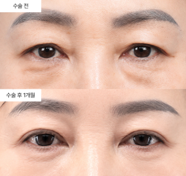 하안검 지방재배치 vs 지방제거, 어떤 걸 선택해야 할까요?