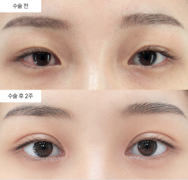 쌍꺼풀 수술이랑 눈매교정, 눈성형 전에 꼭 알아야 할 차이