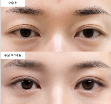 쌍꺼풀 수술이랑 눈매교정, 도대체 뭐가 다른 걸까요?