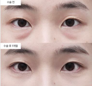 눈밑지방재배치 절개 vs 비절개, 어떤 차이가 있을까요?