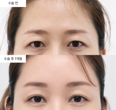 내시경이마거상 후 이마 라인이 부자연스러울 수 있을까요?