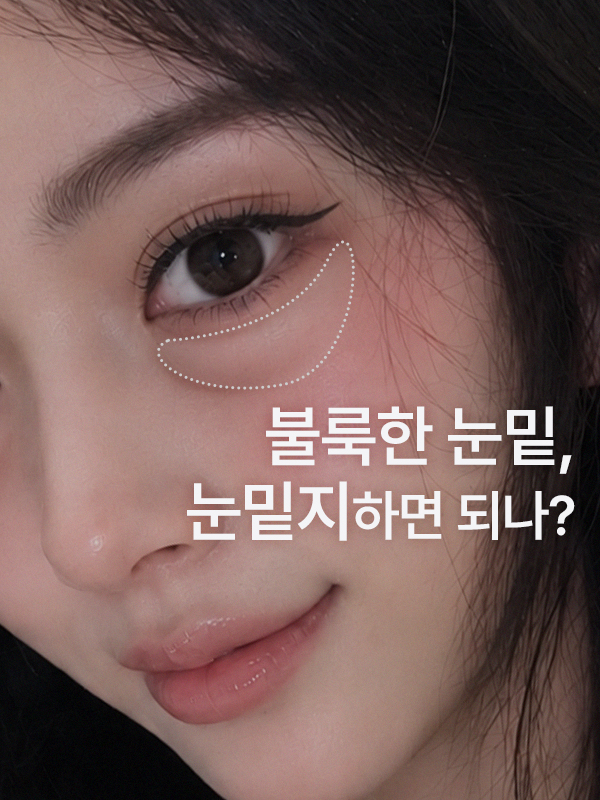눈밑이 불룩한데 눈밑지방재배치만 하면 되나요?