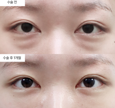 눈밑지방재배치, 몇 살에 받는 게 가장 좋을까요?