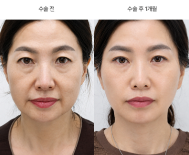 안면거상이랑 실리프팅 차이가 뭔가요?
