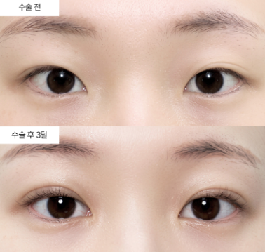 쌍꺼풀 매몰법과 절개법, 회복 과정이 이렇게 달라요