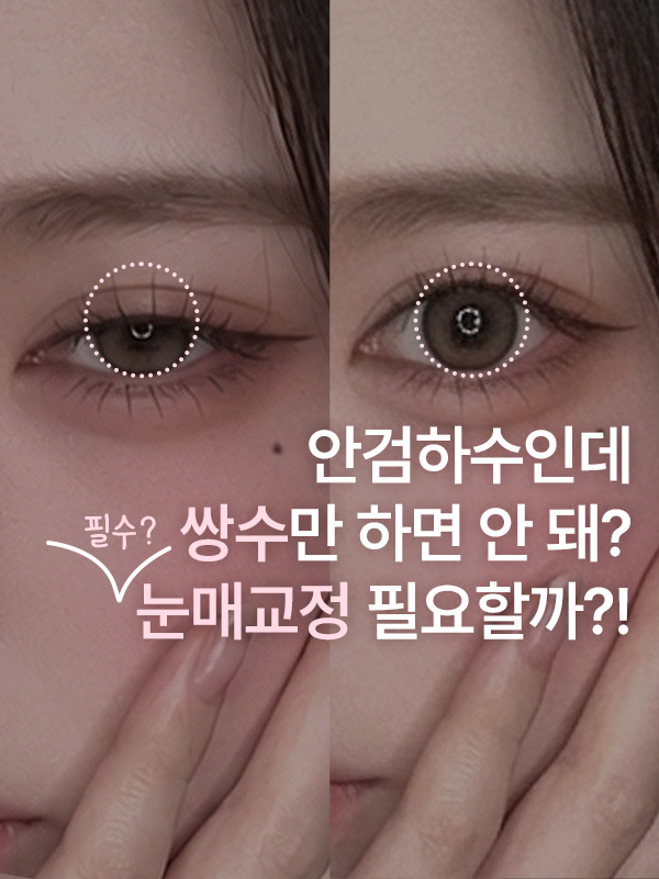 안검하수가 있는데 쌍꺼풀 수술만 하면 안 될까요? 눈매교정도 필요한가요?