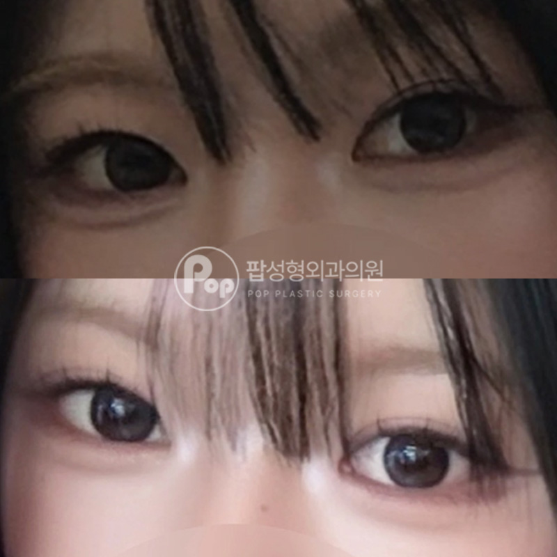 팝성형외과 눈재수술 자연유착 뒤트임 2달차 리얼후기