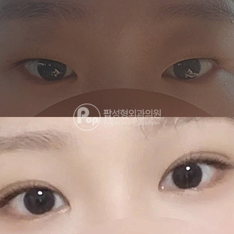 팝성형외과 쌍수 무쌍 인아웃라인 후기
