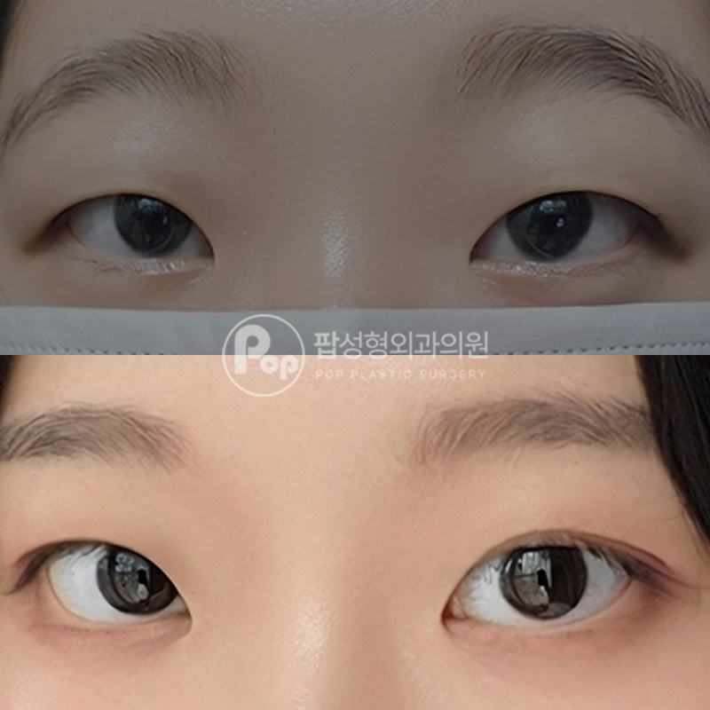 팝성형외과 인아웃라인 자연유착 후기