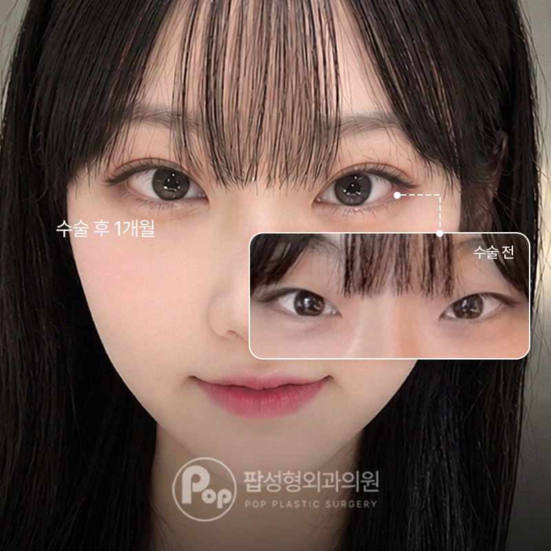 팝성형외과 사나운 인상 자연유착 트임 후기