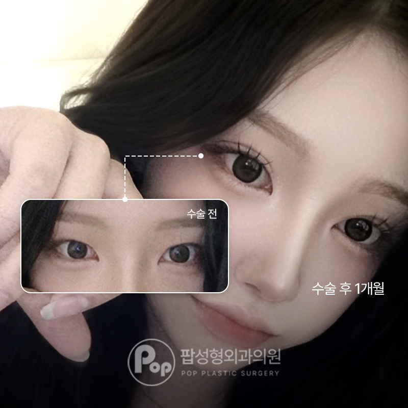 강남 팝성형외과 매몰 눈재수술 트임 1개월 후기