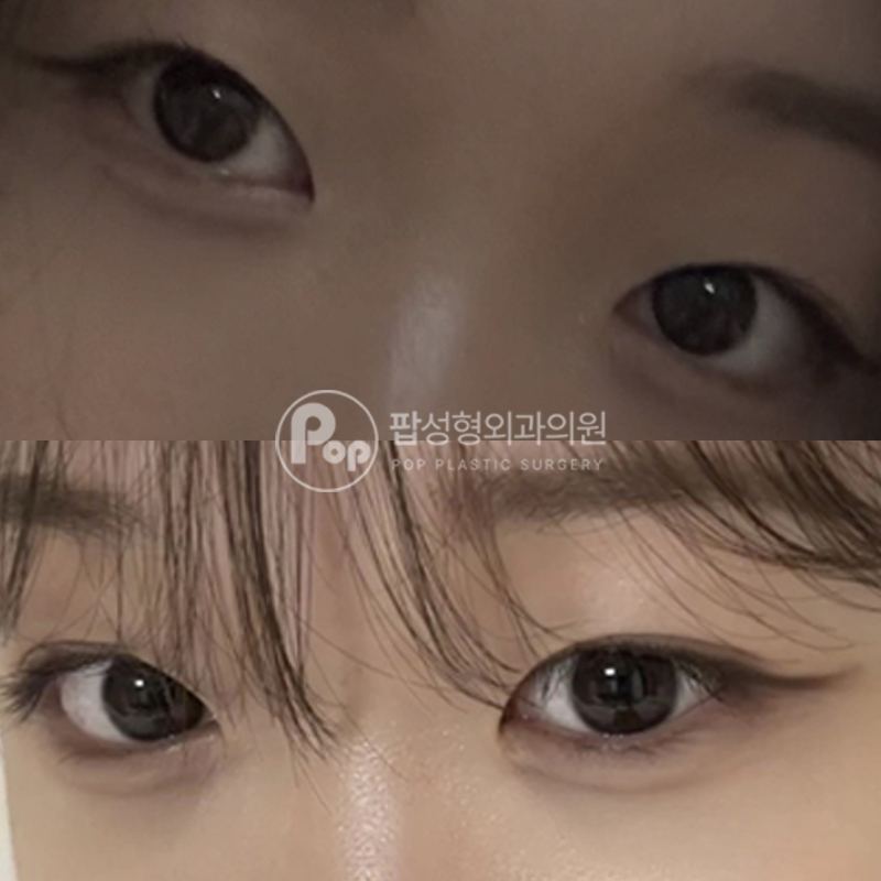 팝성형외과 속쌍 자연유착 첫눈성형 후기