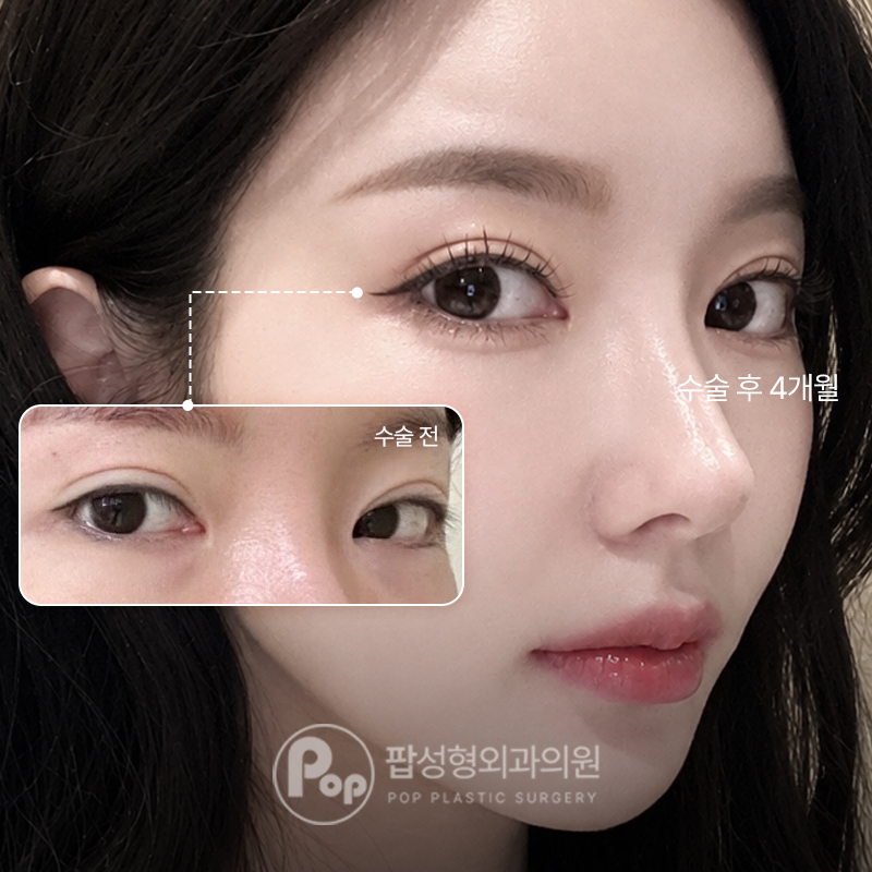 팝성형외과 인아웃라인 졸린눈 쌍수 재수 후기