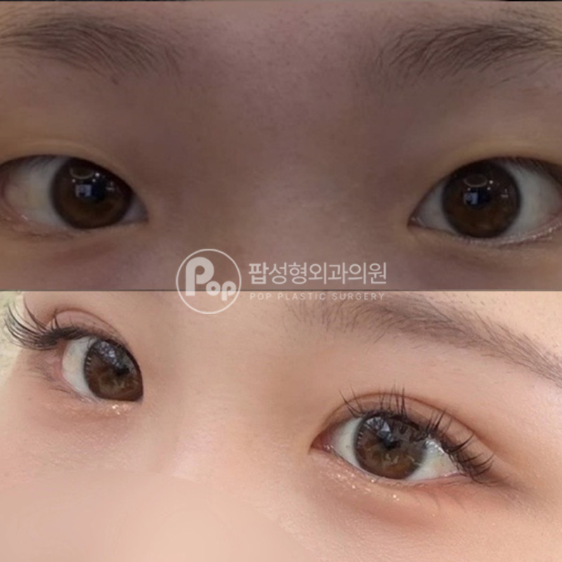 팝성형외과 첫눈 밑트임 자연유착 눈성형 4개월차