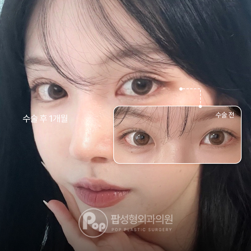 팝성형외과 낮은 라인 세미아웃 눈재수술 경과 후기