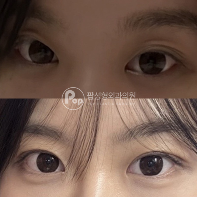 팝성형외과 쌍꺼풀 수술 매몰 눈매교정 1달차