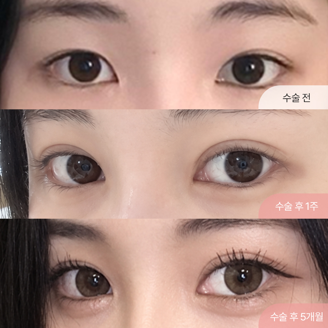 팝성형외과 자연유착+트임+눈매교정 5개월차 경과후기