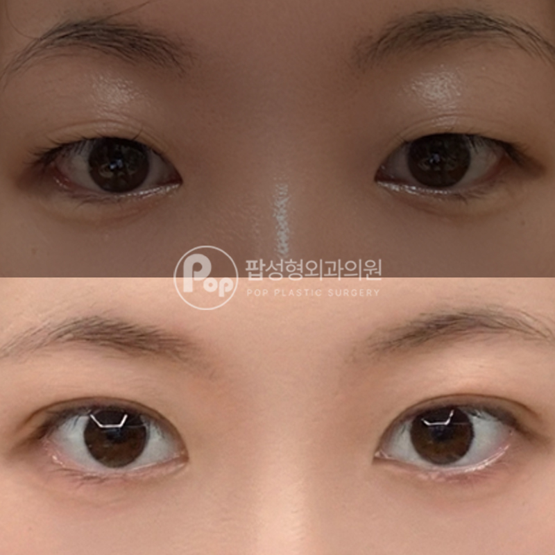 팝성형외과 겹쌍꺼풀 쌍수 자연유착 후기