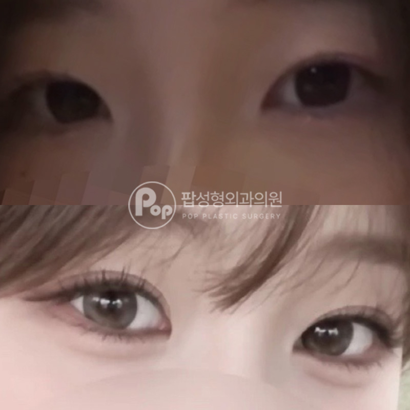 팝성형외과 낮은 쌍꺼풀 자연유착 눈매교정 트임
