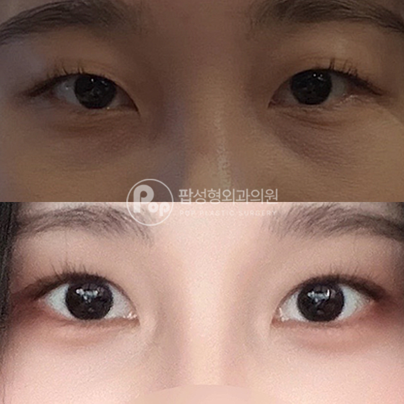 팝성형외과 눈밑지방재배치 후기