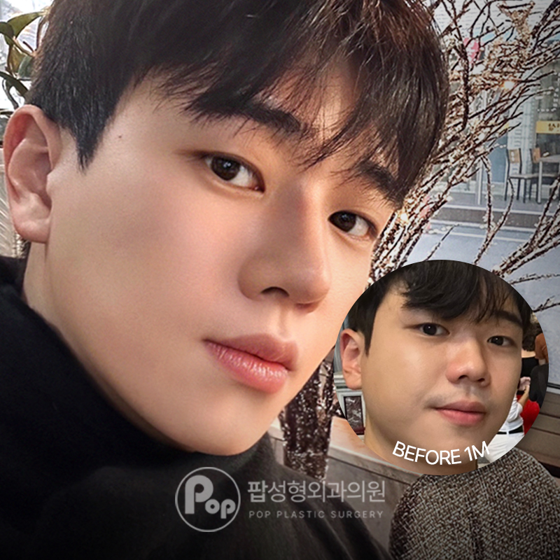 팝성형외과 남자코성형 콧볼축소 후기