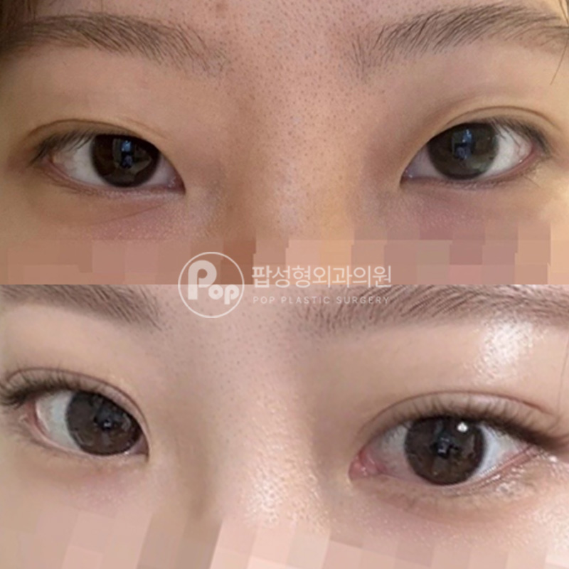 팝성형외과 답답한 눈 세미아웃라인 눈재수술