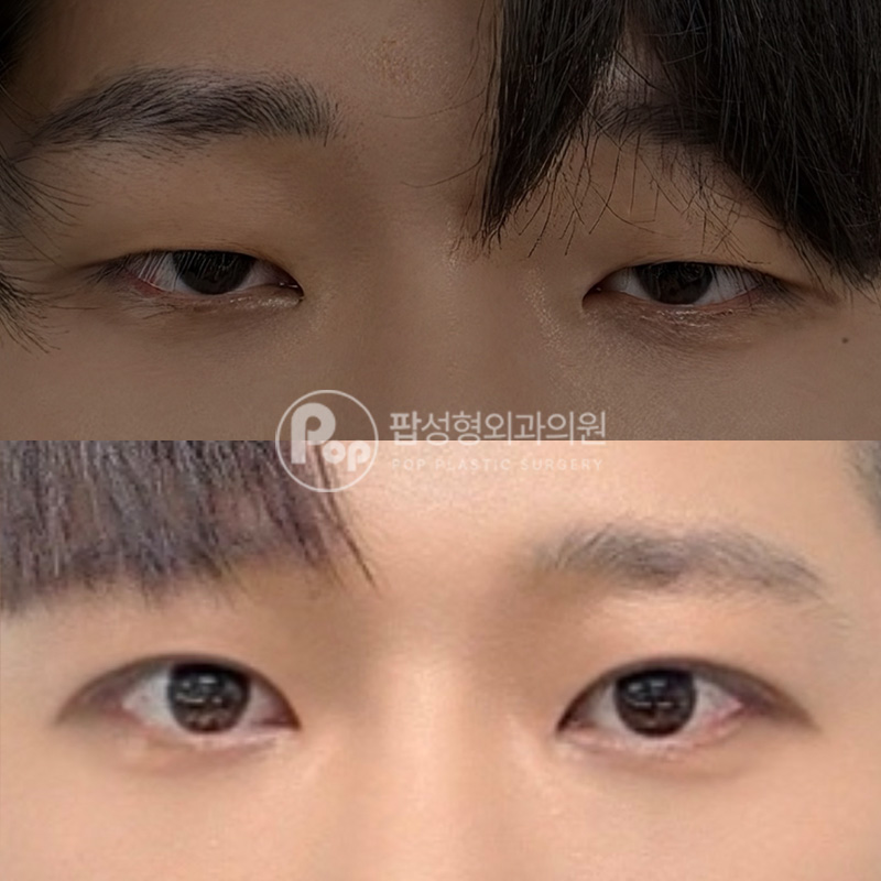 팝성형외과 졸린눈 남자눈성형 후기