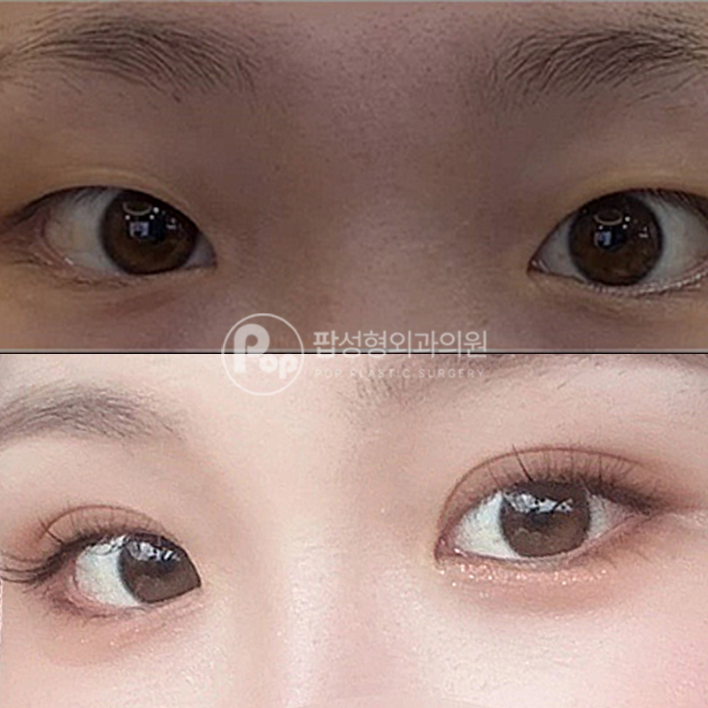 팝성형외과 늘어진 눈 자연유착 후기