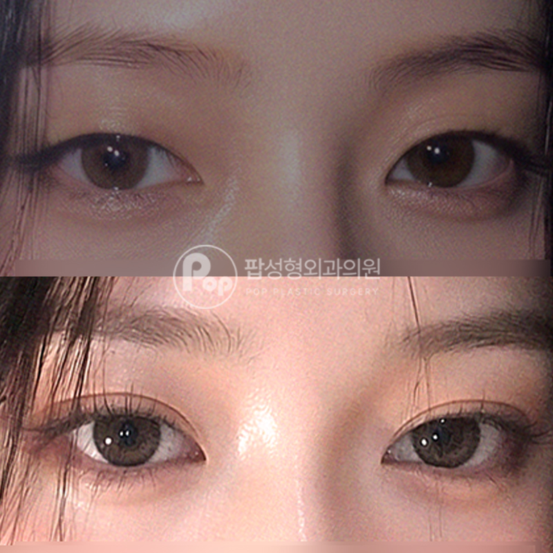팝성형외과 무쌍 자연유착 후기!