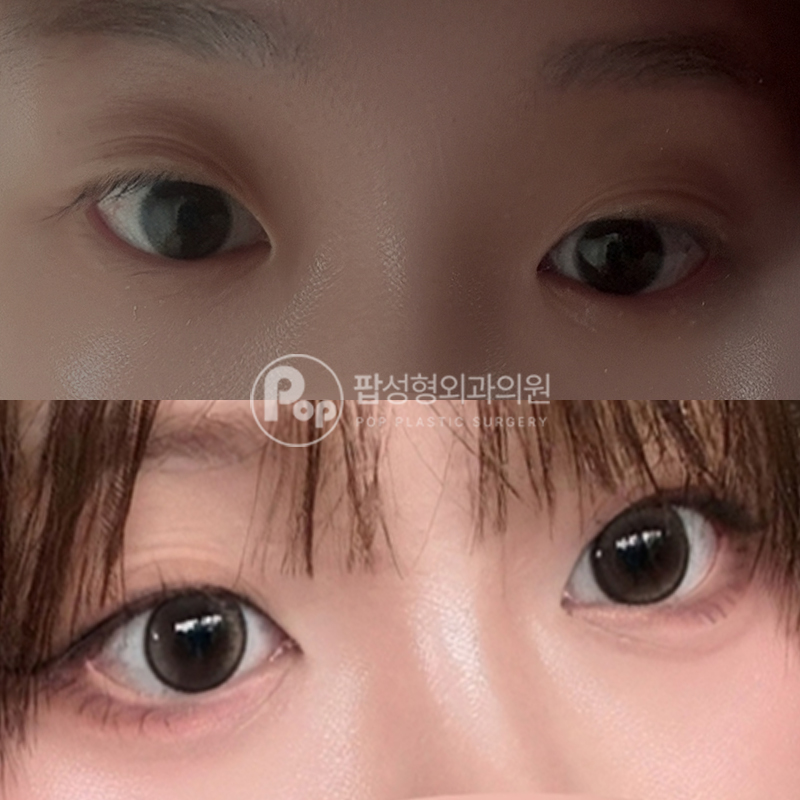 팝성형외과 뒤밑트임 후기