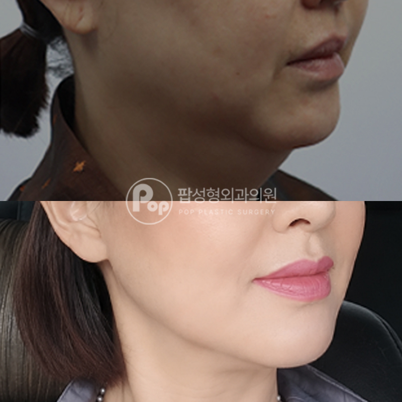 강남 팝성형외과 미니거상 1년차 경과 후기
