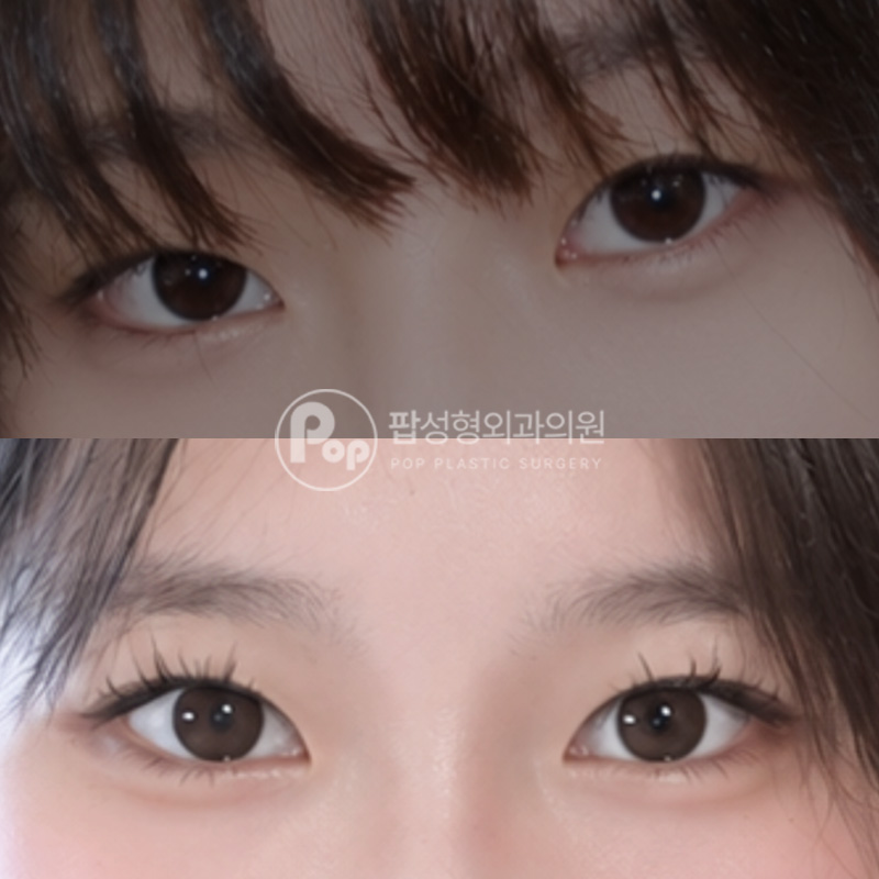 팝성형외과 첫쌍수 인라인 자연유착 눈매교정