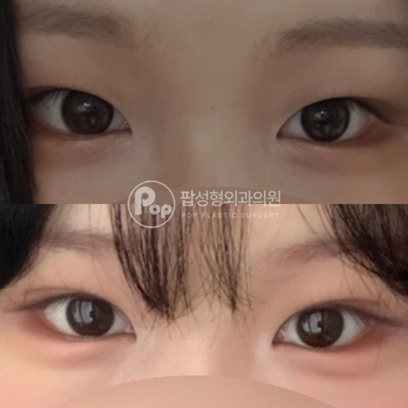 팝성형외과 눈매교정 자연유착 후기