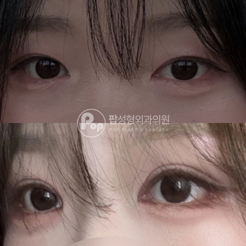 팝성형외과 눈재수술 트임 1개월차 후기