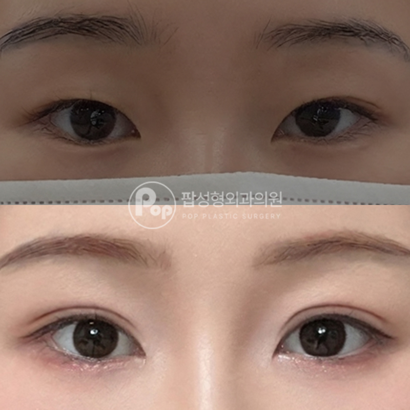 팝성형외과 아웃라인 첫눈성형 자연유착 후기