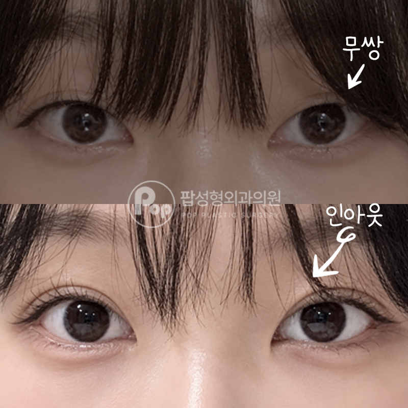 팝성형외과 무쌍 사나운 눈매 쌍수 뒤밑트임 후기