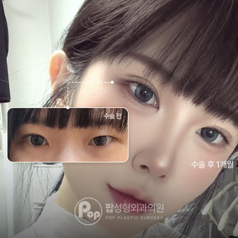 팝성형외과 짝눈 비대칭라인 자연유착 눈재수술 후기