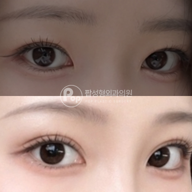 팝성형외과 낮은 라인 세미아웃 자연유착 눈재수술 후기