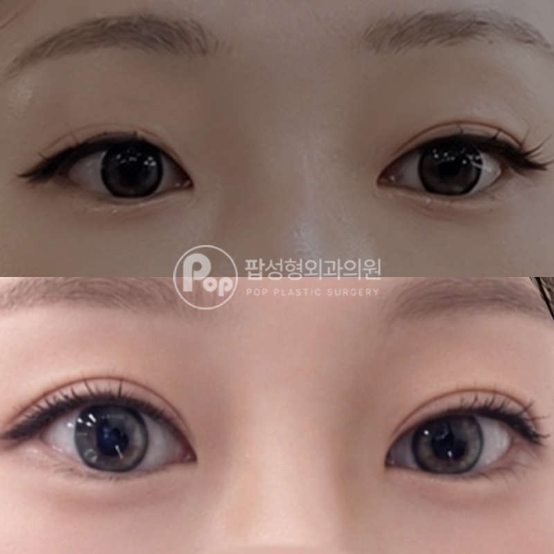 팝성형외과 풀린 라인 매몰 재수술 후기